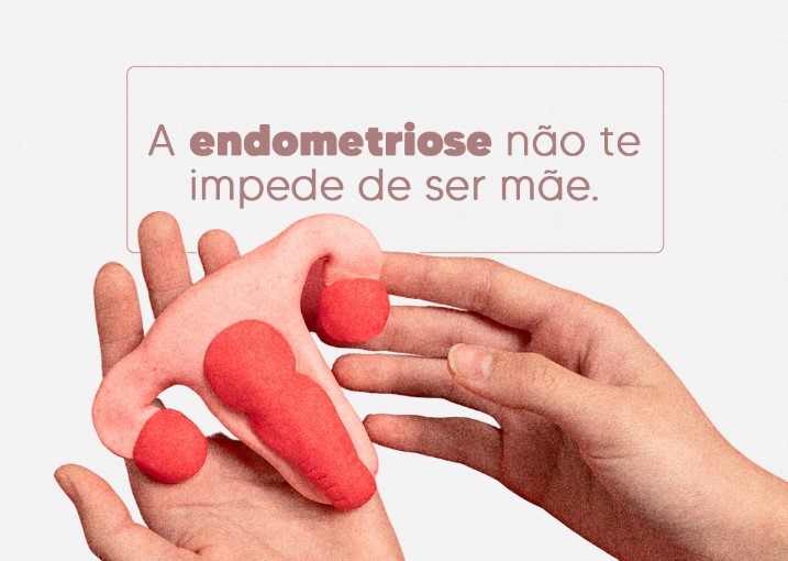 endometriose-nao-impede-de-ser-mae-dra-monica-jorge-ginecologista-especialista-reproducao-humana-infertilidade-diagnostico