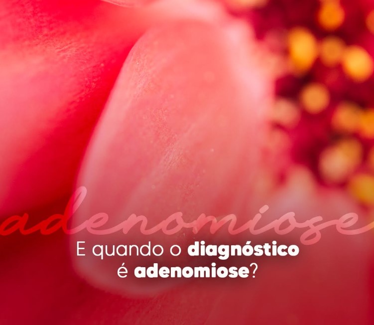 adenomiose-e-gravidez-dra-monica-jorge-ginecologista-especialista-reproducao-humana-infertilidade-diagnostico-fiv-fertilizacao-in-vitro-campinas